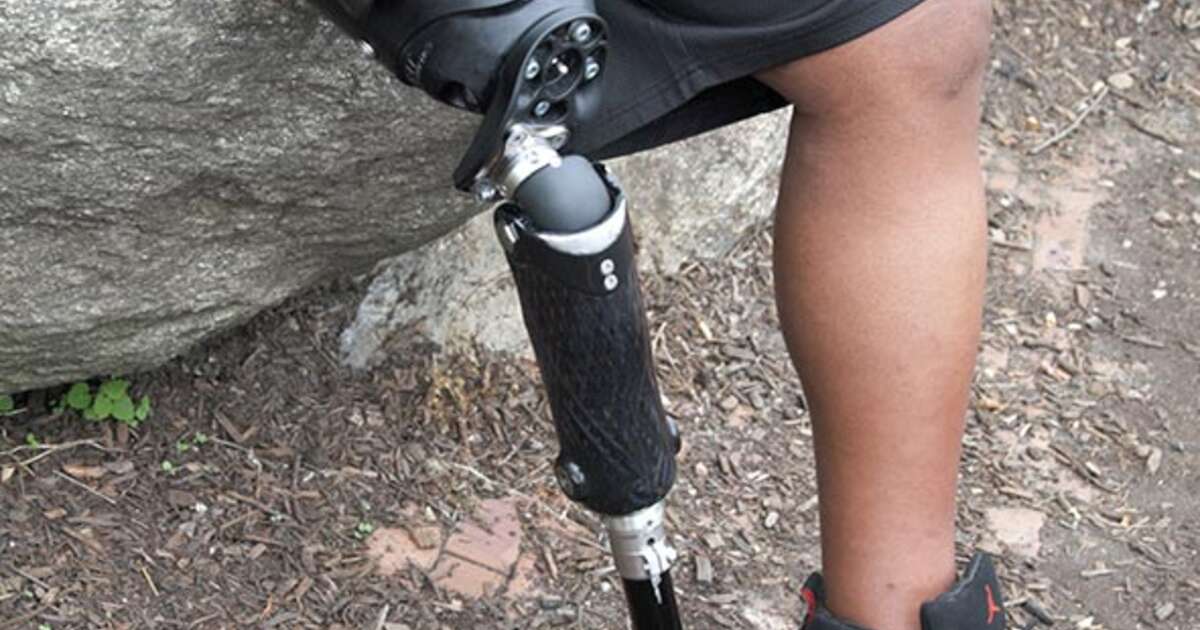 iFIT Transfemoral Prosthesis Products Allard USA